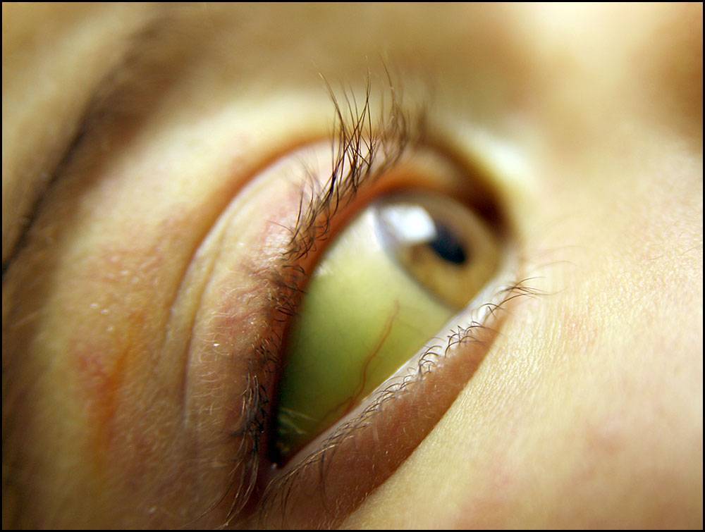 Желтые белки глаз цирроз thumbnail