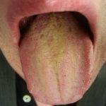 Причины желтого налета на языке и горечи во рту