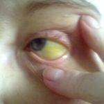 Как желтеют глаза при гепатите, циррозе, желтухе?