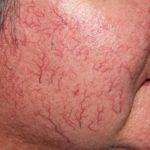 Сыпь на лице при гепатите 20