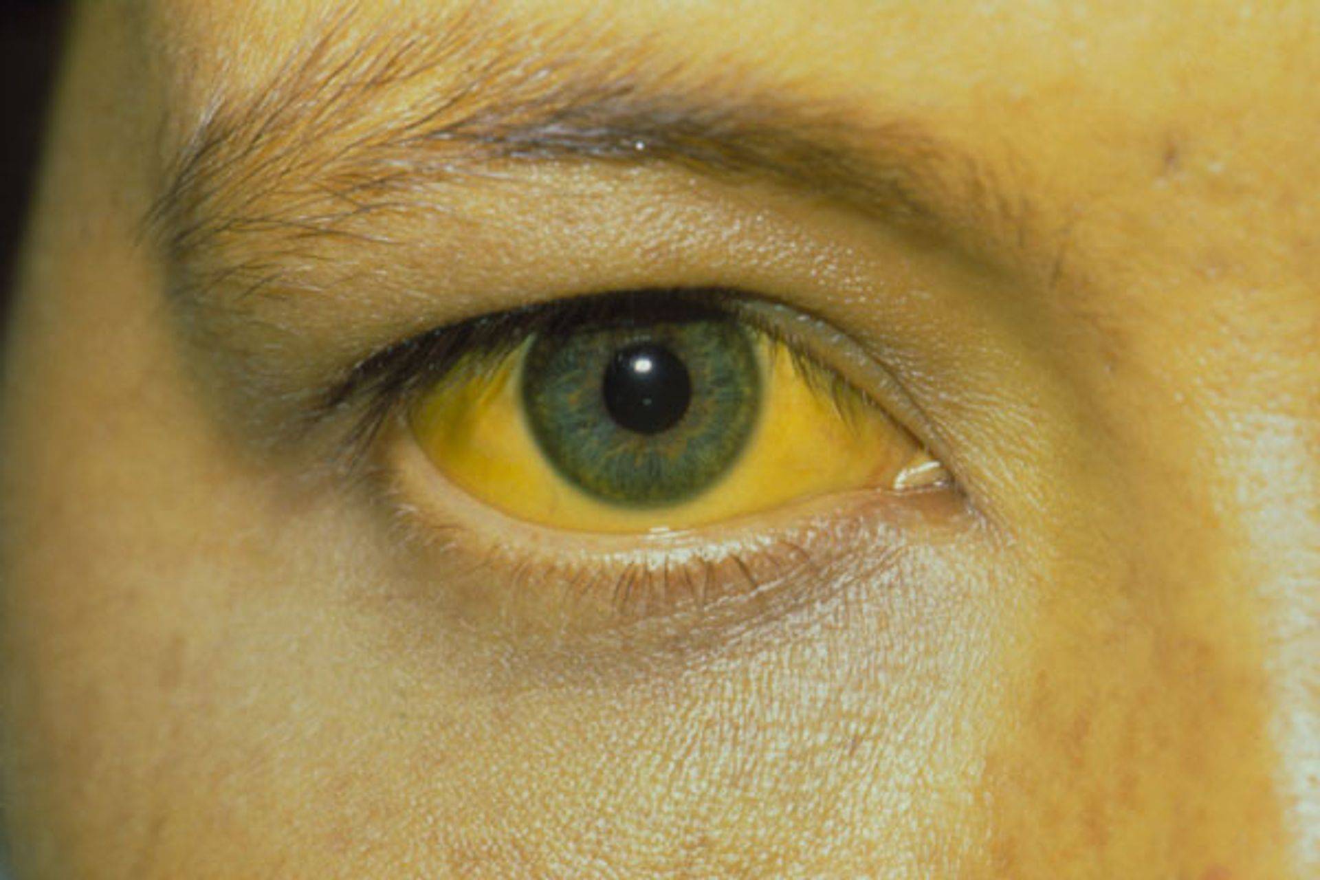 Описание желтых глаз. Гемолитическая желтуха болезнь Боткина. Желтуха кожи и склер при гепатите а. Пожелтение склер гепатит.
