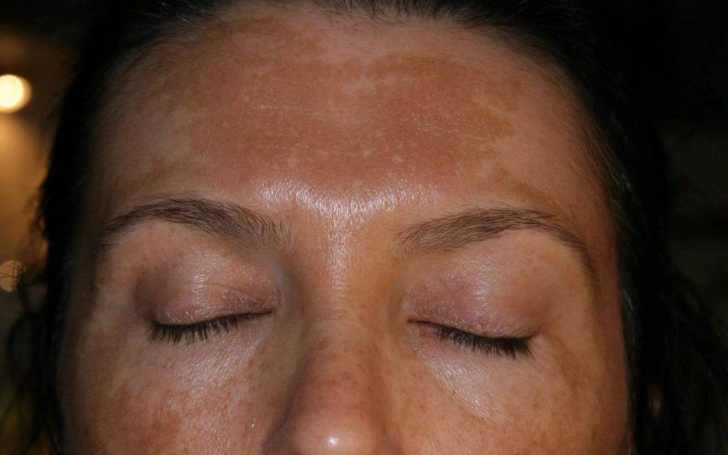 Печеночные пятна на коже лица лечение thumbnail