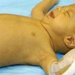 Умеренная гепатомегалия у ребенка: что это такое?