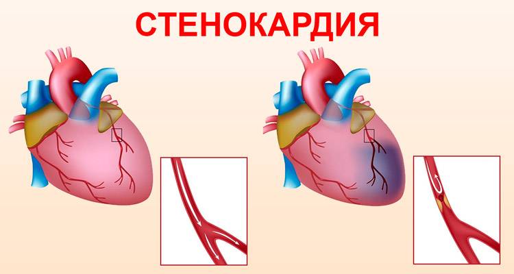 Предуктал: инструкция по применению, отзывы кардиологов и пациентов