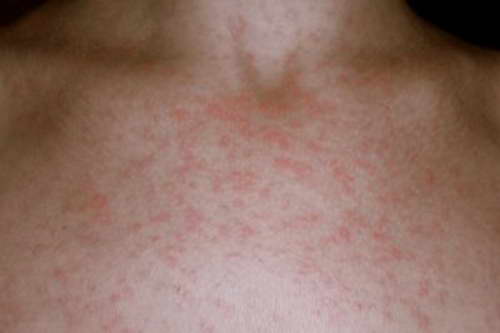 Аллергия на парацетамол как лечить