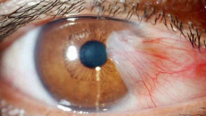 Кровоизлияние в переднюю камеру глаза фото