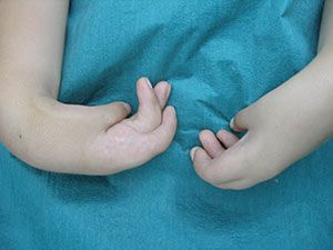 Дисплазия соединительной ткани: симптомы и лечение у детей