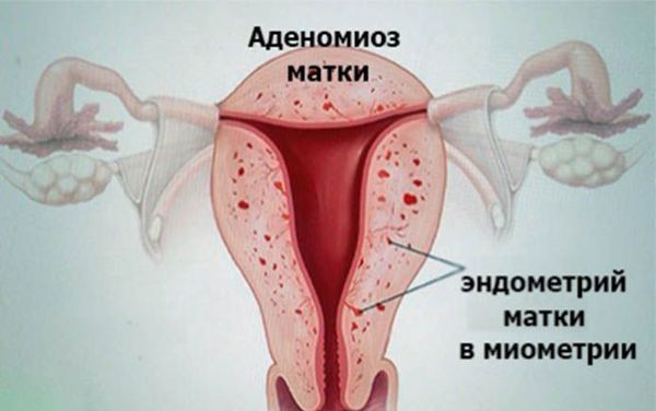 Аденомиоз матки: признаки, симптомы, лечение, признаки. как лечить аденомиоз матки
