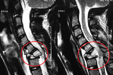 Перелом шейного позвоночника последствия. Компрессионная миелопатия с3-с4. Компрессионная миелопатия шейного отдела позвоночника мрт. Компрессионный перелом позвонков мрт. Компрессионный перелом шейного отдела позвоночника мрт.