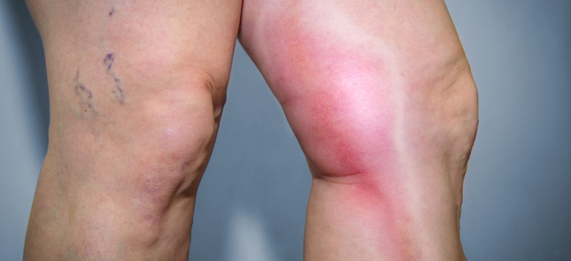 Как лечить рожистое воспаление ноги в домашних условиях - лечение ног