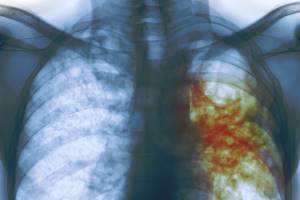 Туберкулез органов дыхания с широкой лекарственной устойчивостью у взрослых