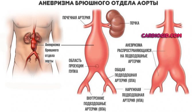 Аневризма в грудной части аорты