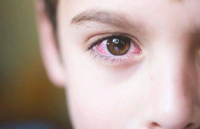 Гноятся глаза у ребенка чем лечить народными средствами