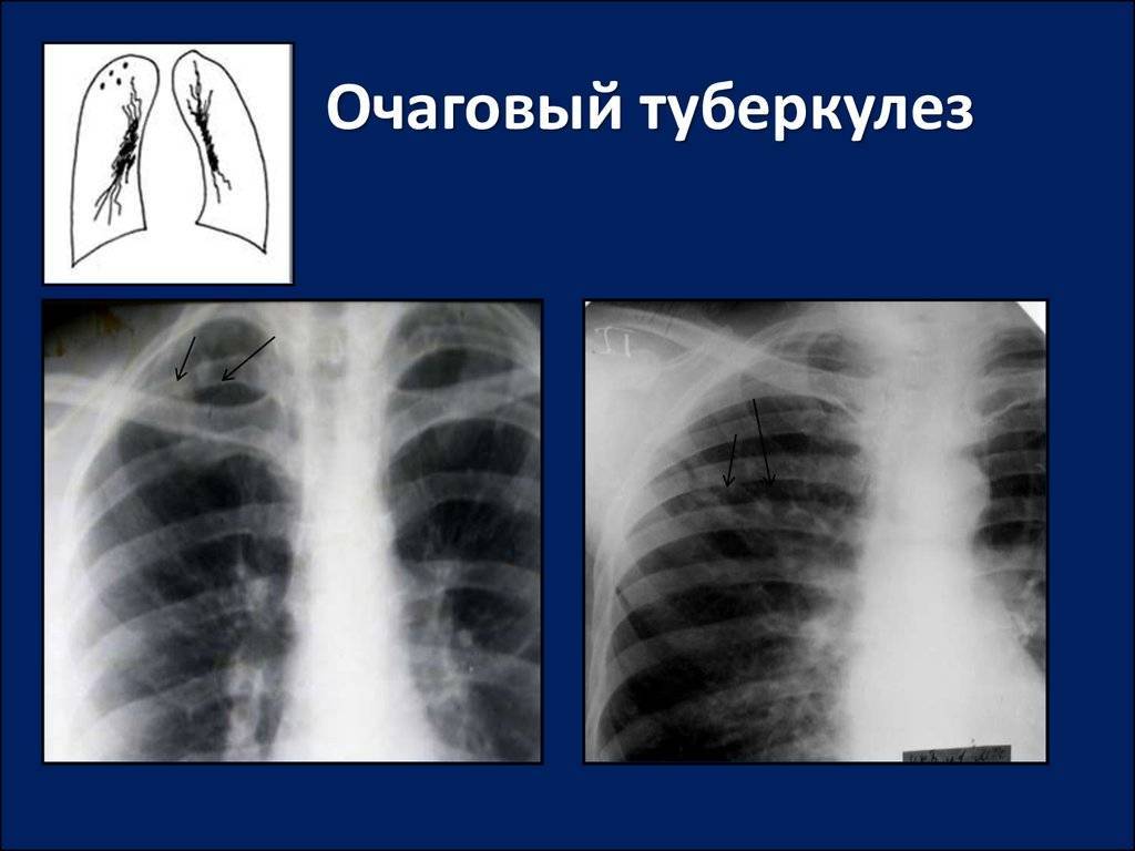 Туберкулез – лечится или нет: можно ли вылечить легкие полностью