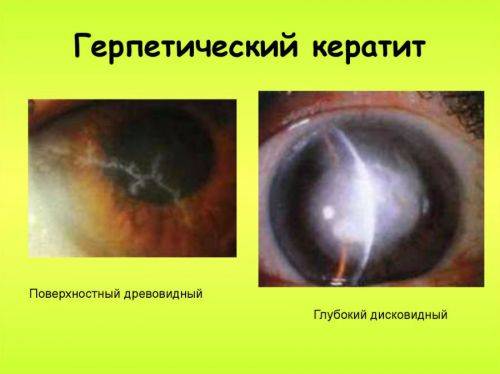 Воспаление глаза роговицы: причины, симптомы, лечение