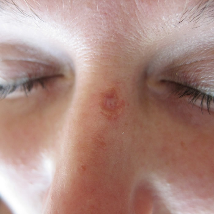 Базалиома кожи лица: фото разных стадий, лечение, мази