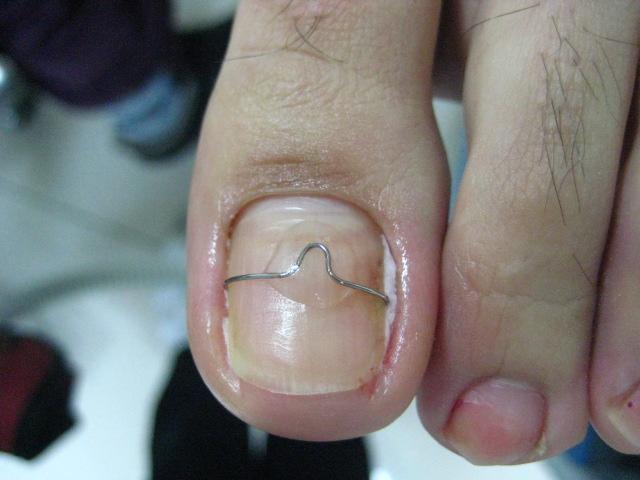 Вросший ноготь на большом пальце ноги – лечение, удаление вросшего ногтя