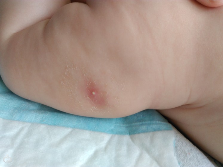 Опухоль в месте прививки у ребенка: норма или патология
