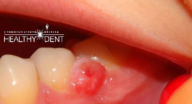 Киста на десне около зуба у взрослого и ребенка: причины, симптомы, удаление, лечение и народная терапия