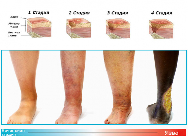 Трофическая язва на ноге лечение препараты мази