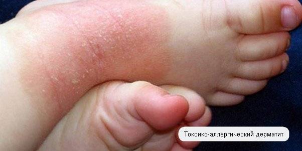 Токсико аллергический дерматит лечение