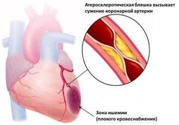 Атеросклеротический кардиосклероз: причины, симптомы и лечение