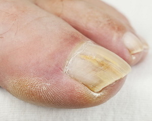 Онихомикоз ногтей: симптомы, как и чем лечить