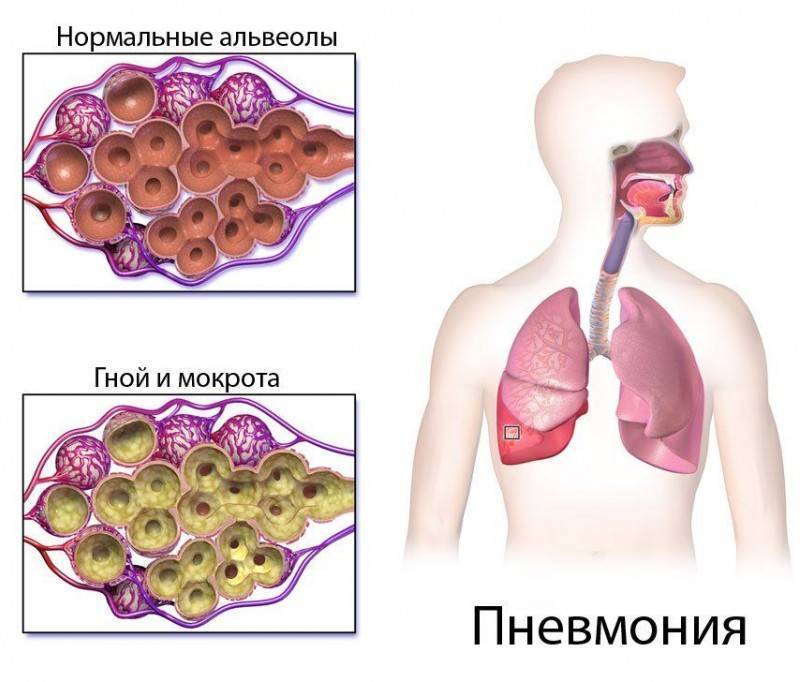 Пневмония или туберкулез