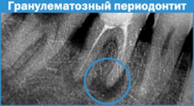 Консервативные способы лечения кисты и гранулемы зуба без оперативного вмешательства