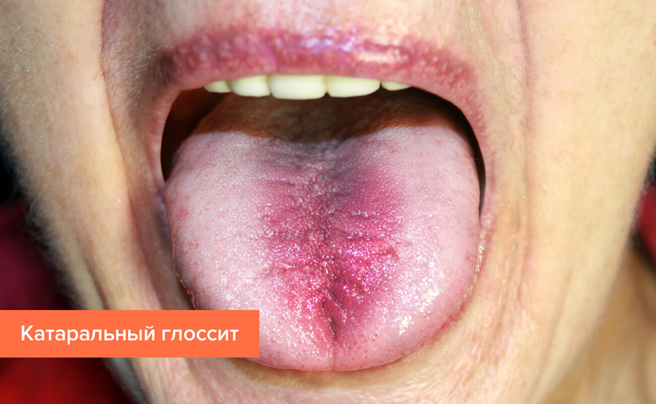 Диагностика – как лучший помощник лечения глоссита языка