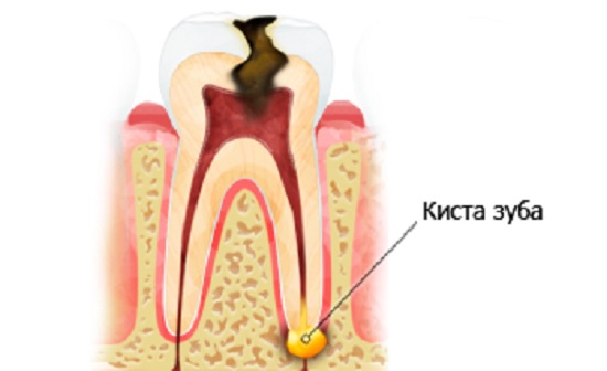 Лечение кисты зуба без удаления