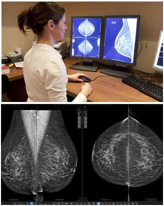 Что лучше: маммография или узи молочных желез