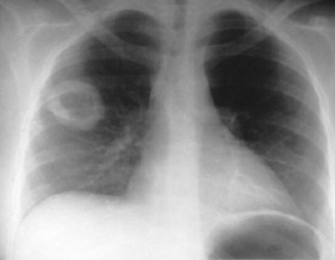 Туберкулез на компьютерной томографии: варианты и их проявления