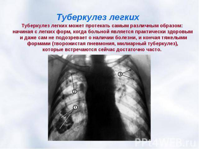 Может ли пневмония перерастать в туберкулез