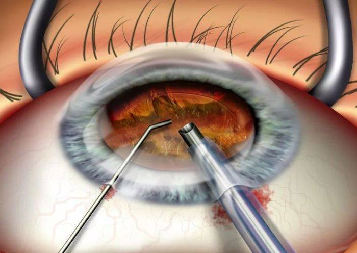 Как долго восстанавливается зрение после удаления катаракты