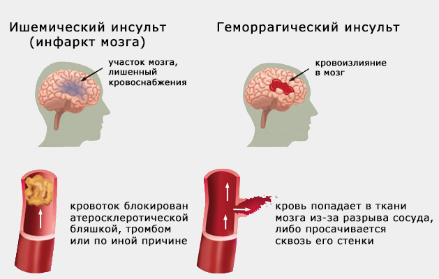 Глутаминовая кислота и болезни мозга