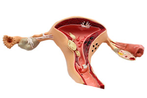 Полип эндометрия матки: причины, симптомы, как лечить