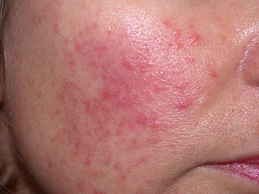 Аллергические прыщи на лице: причины, лечение, как быстро избавиться от алл...