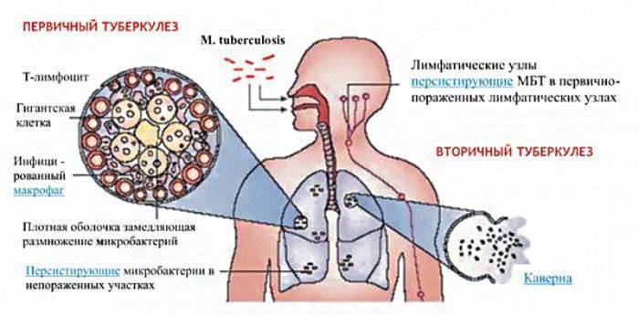 Туберкулез – симптомы и первые признаки