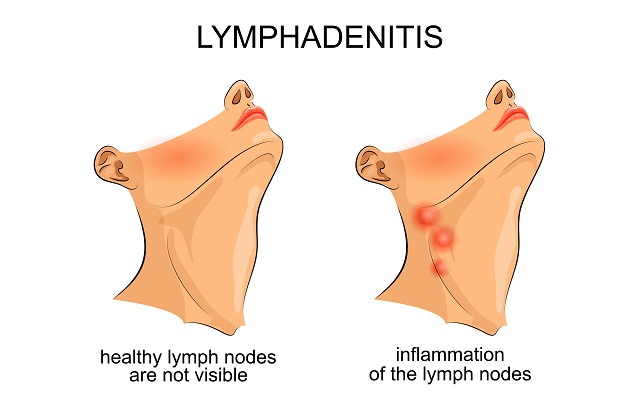 Медиастинальная лимфаденопатия как проявление опасных заболеваний