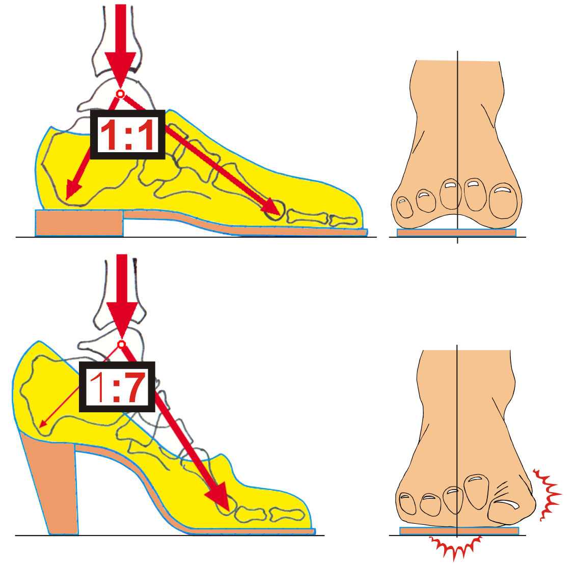 Деформация ног от узкой обуви