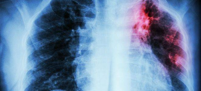 Погибает ли туберкулез при кипячении