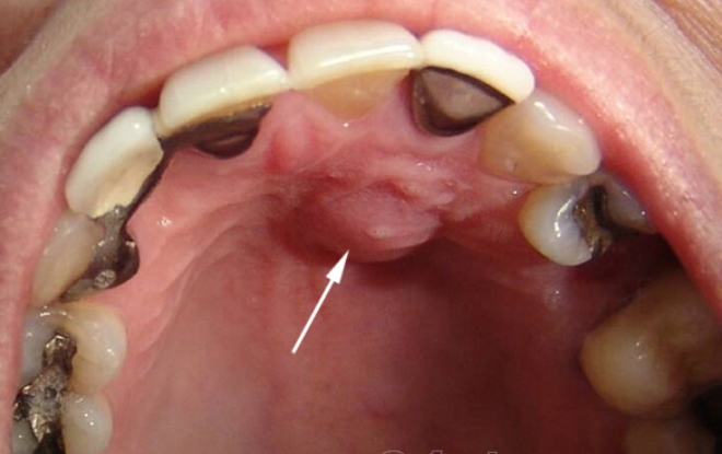 Что такое киста зуба и как её лечить