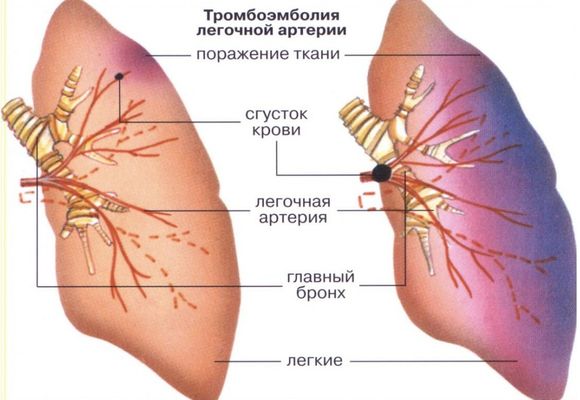 Тромбоэмболия легочных артерий