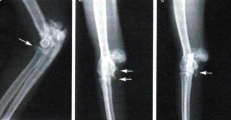 Причины, рекомендации и ограничения при костно-хрящевом экзостозе колена