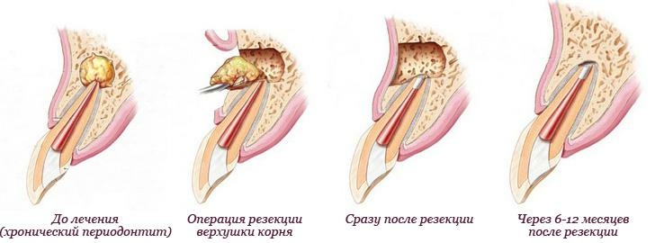 Способы удаления кисты зуба и восстановление десны после операции