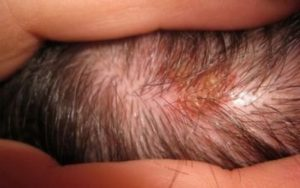 Грибок кожи головы: симптомы и лечение