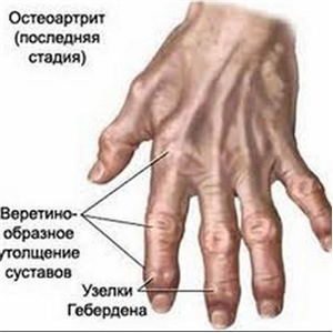 Ревматоидный артрит, основные симптомы болезни