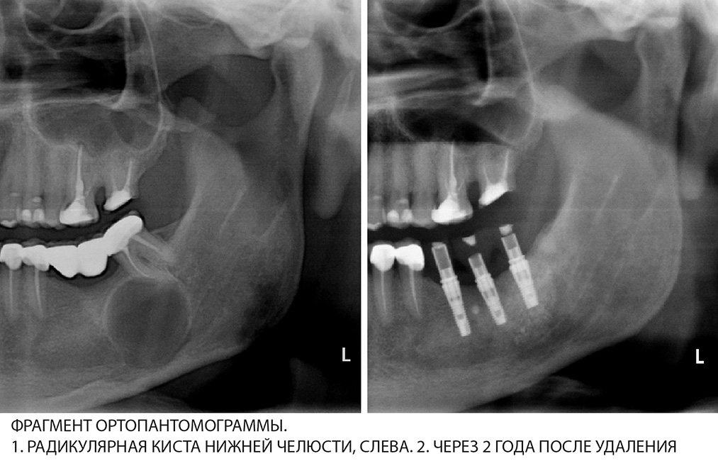 Киста в зубе – что это такое? виды, причины и симптомы, способы лечения