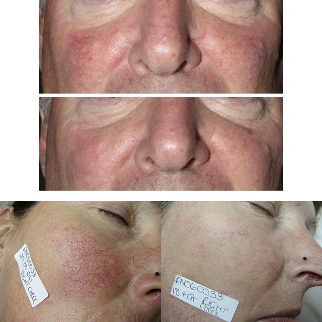 Купероз на лице: причины и лечение, удаление сосудистых звездочек лазером на лице и ногах